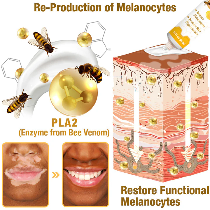 BBOJI™ BeeVenom Vitiligo Treatment Cream