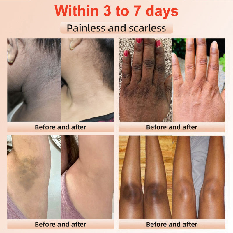 NESLEMY™ gentle Purifying Exfoliating Gel for Acanthosis Nigricans and Dark Spots,ect