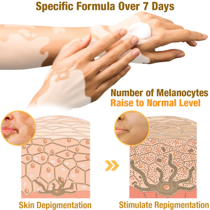 BBOJI™ BeeVenom Vitiligo Treatment Cream