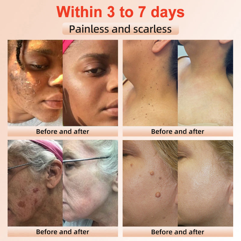 NESLEMY™ gentle Purifying Exfoliating Gel for Acanthosis Nigricans and Dark Spots,ect