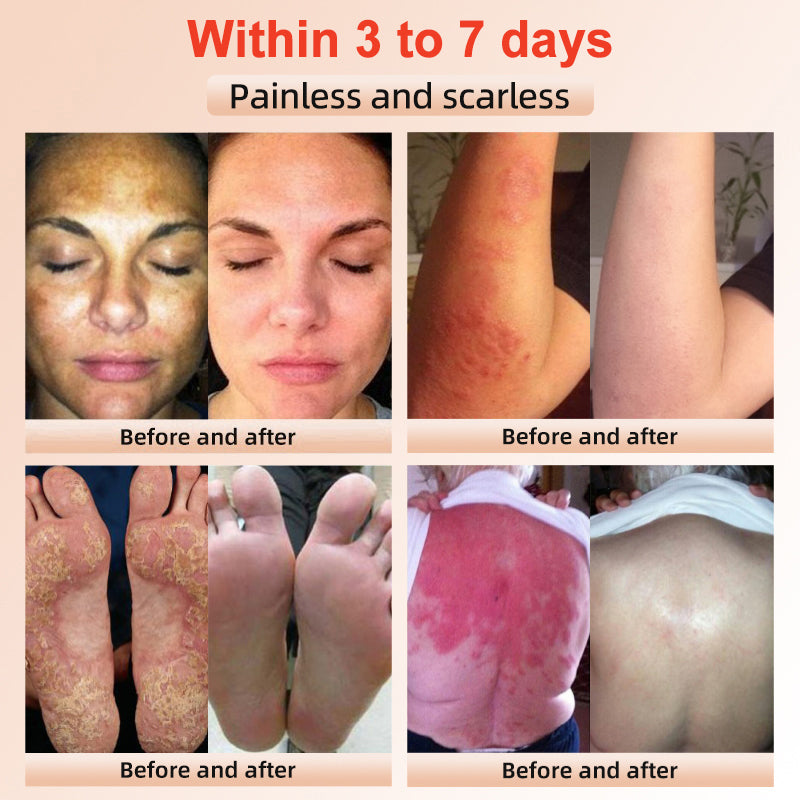 NESLEMY™ gentle Purifying Exfoliating Gel for Acanthosis Nigricans and Dark Spots,ect