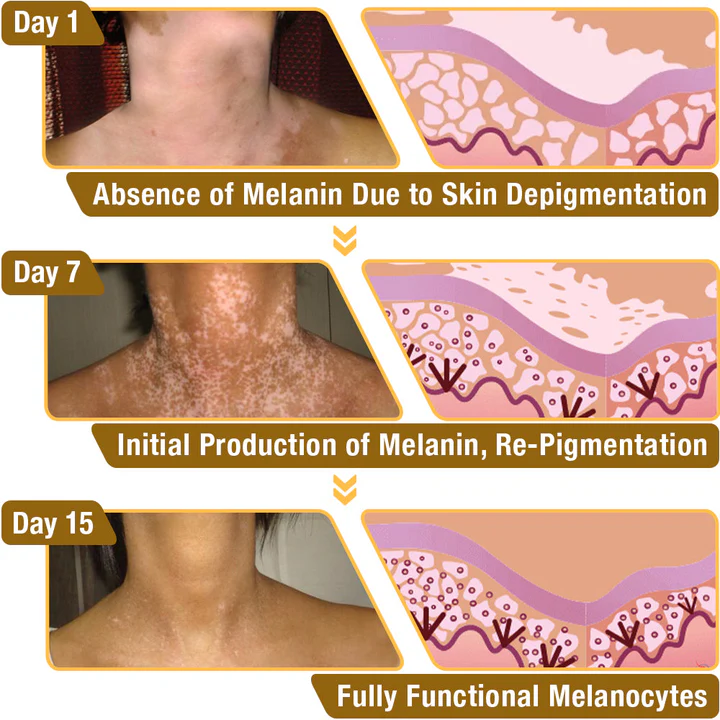 BBOJI™ BeeVenom Vitiligo Treatment Cream