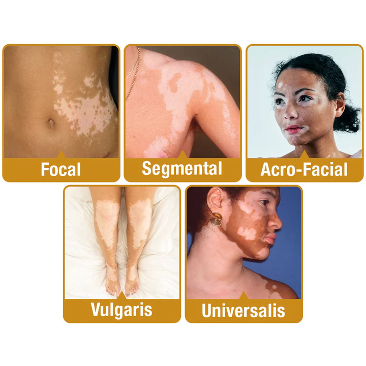BBOJI™ BeeVenom Vitiligo Treatment Cream