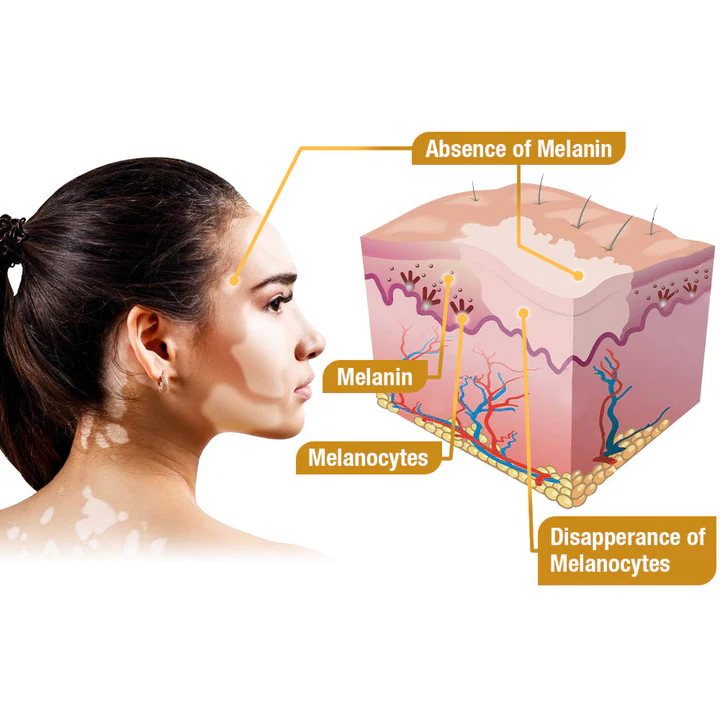 BBOJI™ BeeVenom Vitiligo Treatment Cream