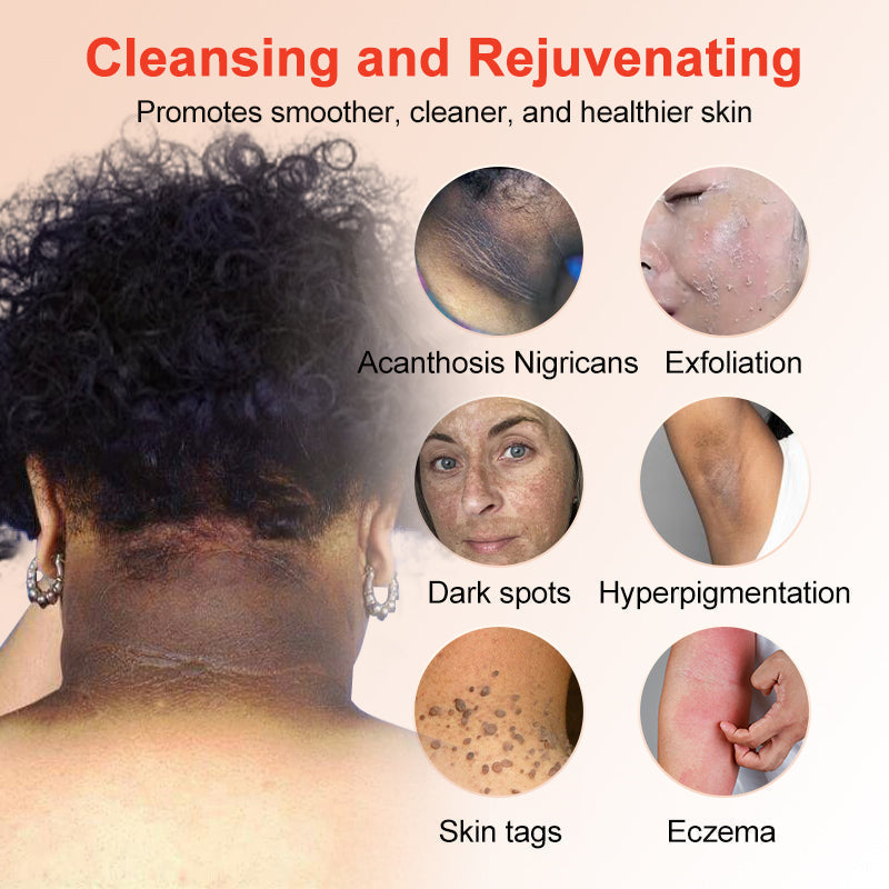 NESLEMY™ gentle Purifying Exfoliating Gel for Acanthosis Nigricans and Dark Spots,ect
