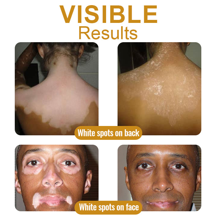 BBOJI™ BeeVenom Vitiligo Treatment Cream