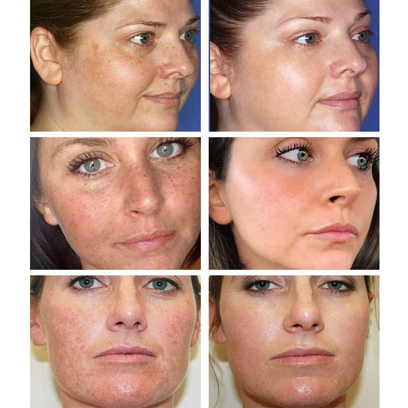 Bloobeac® Blemish Cream – Fade Age Spots, Freckles & Wrinkles | Youthful, Radiant Skin
