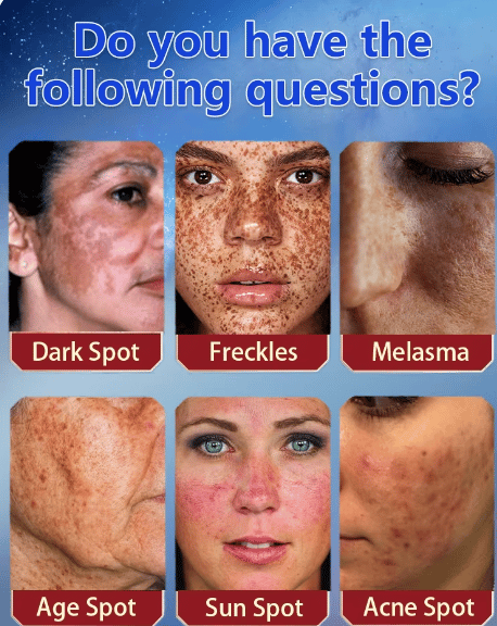 Bloobeac® Blemish Cream – Fade Age Spots, Freckles & Wrinkles | Youthful, Radiant Skin