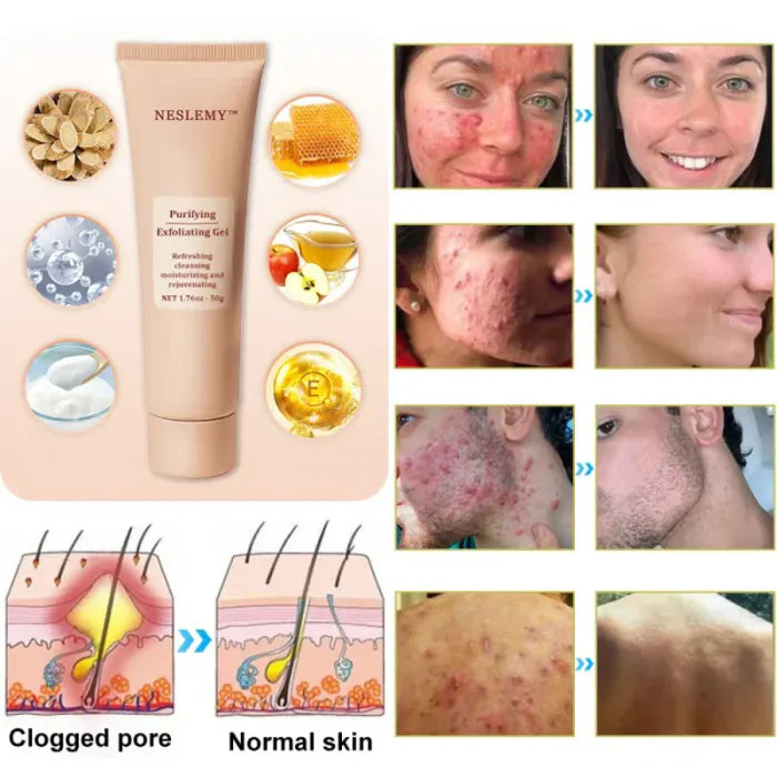 NESLEMY™ gentle Purifying Exfoliating Gel for Acanthosis Nigricans and Dark Spots,ect